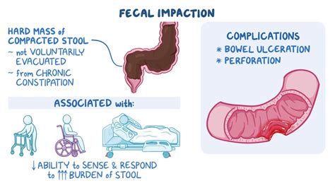 test for fecal impaction|Fecal Impaction: Impacted Bowel Symptoms and .